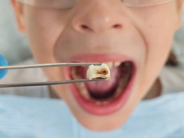 Best Emergency Treatment for Dental Infections or Abscesses in Liberty, PA